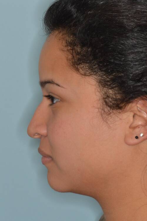 Hispanic Rhinoplasty - Anthony Bared, M.D., F.A.C.S