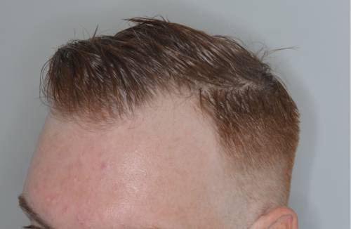 The 13 Best Proven Hair Loss Treatments For Men In 2021 The 13 Best Proven Hair Loss Treatments For Men In 2021