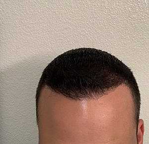 Patient After