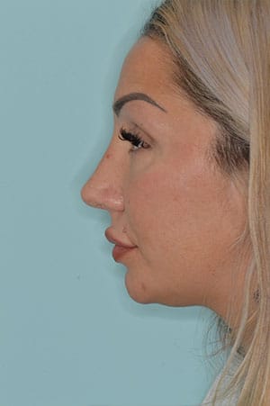 Patient After
