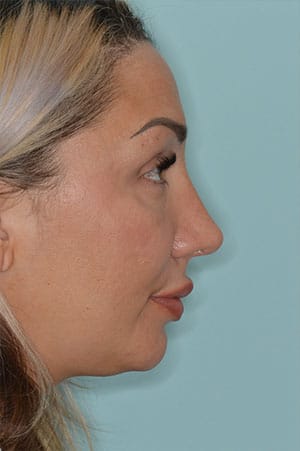Patient After