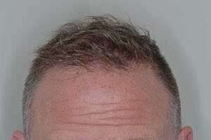 Patient After