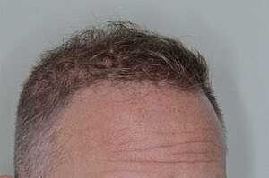 Patient After