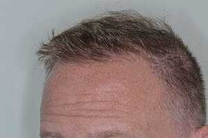 Patient After