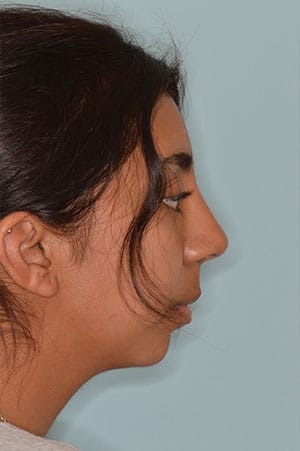 Patient After