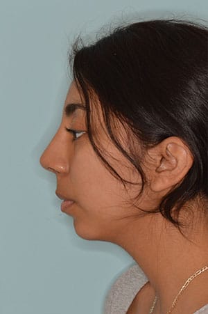 Patient After