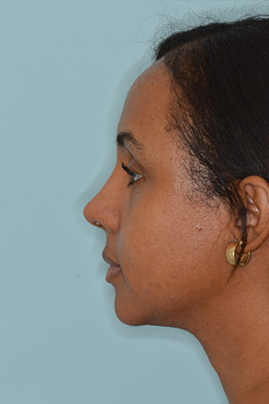 Patient After