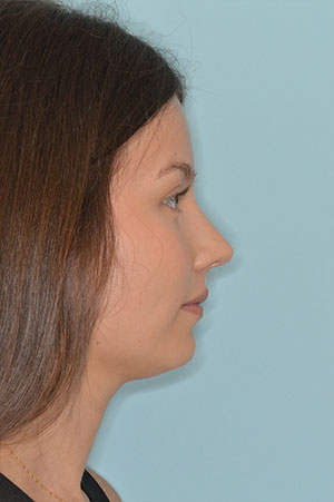 Patient After