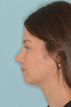 Patient After