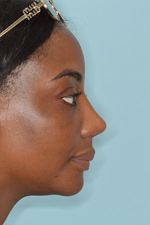 Patient After