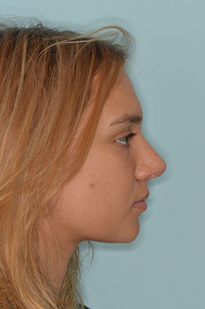 Patient After