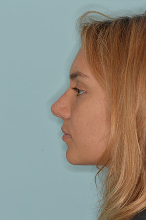 Patient After