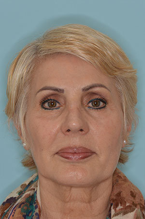 Patient After