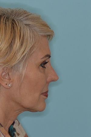 Patient After