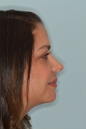 Patient After