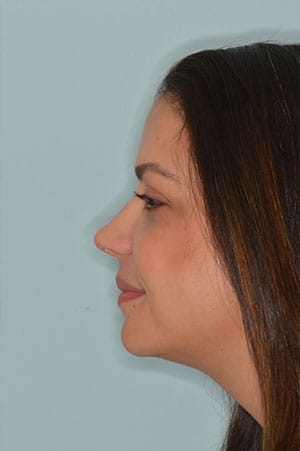 Patient After