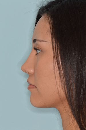 Patient After