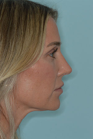 Patient After