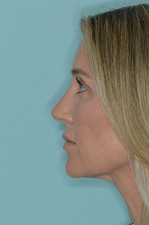 Patient After