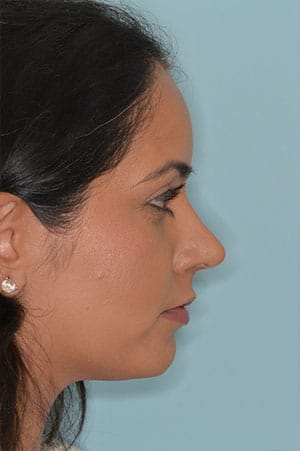 Patient After