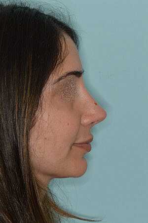 Patient After